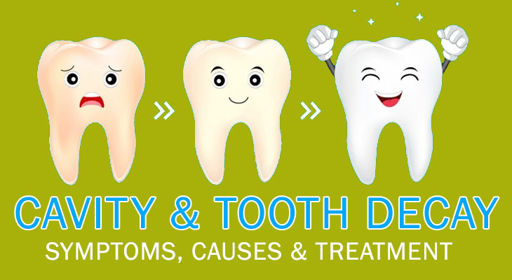 CAVITY & TOOTH DECAY : SYMPTOMS, CAUSES & TREATMENT