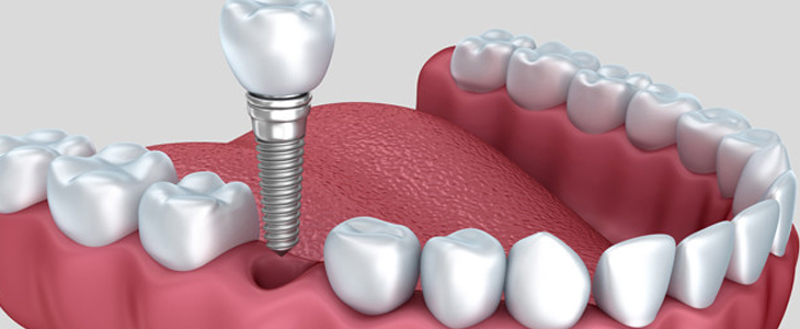 Dental-Implants-Treatment-Ajmer