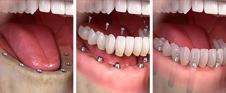 Full-Mouth-implant-treatment-Ajmer