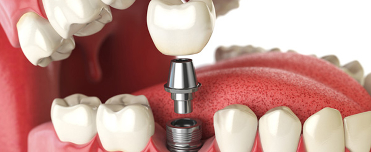 Single & Multiple teeth implant