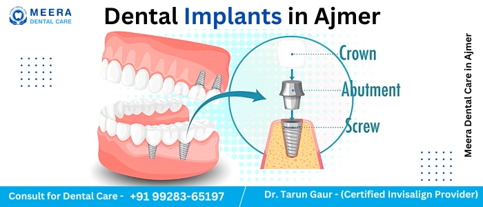 Dental Implants Treatment in Ajmer