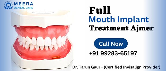 Full Mouth Implant Treatment in Ajmer