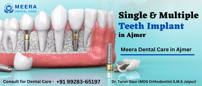 Single & Multiple Teeth Implant Treatment in Ajmer