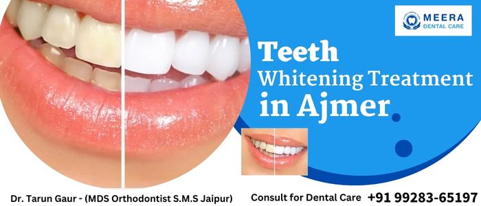 Teeth Whitening Treatment Ajmer