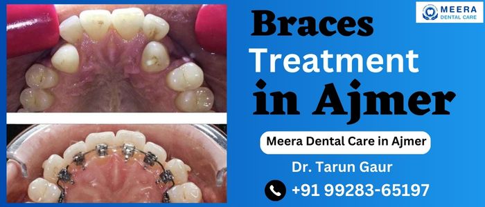 Braces Treatment in Ajmer