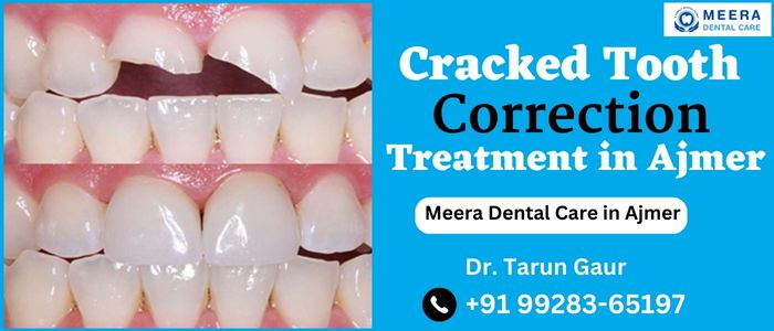 Cracked Tooth Correction Treatment Ajmer
