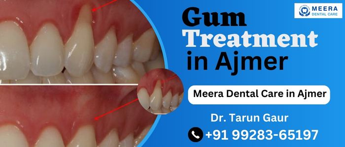 Best Gum Treatment in Ajmer