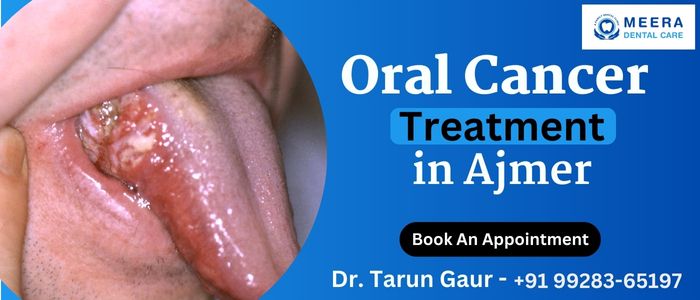 Oral Cancer in Treatment Ajmer